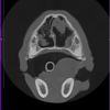 CT-scan Atilla